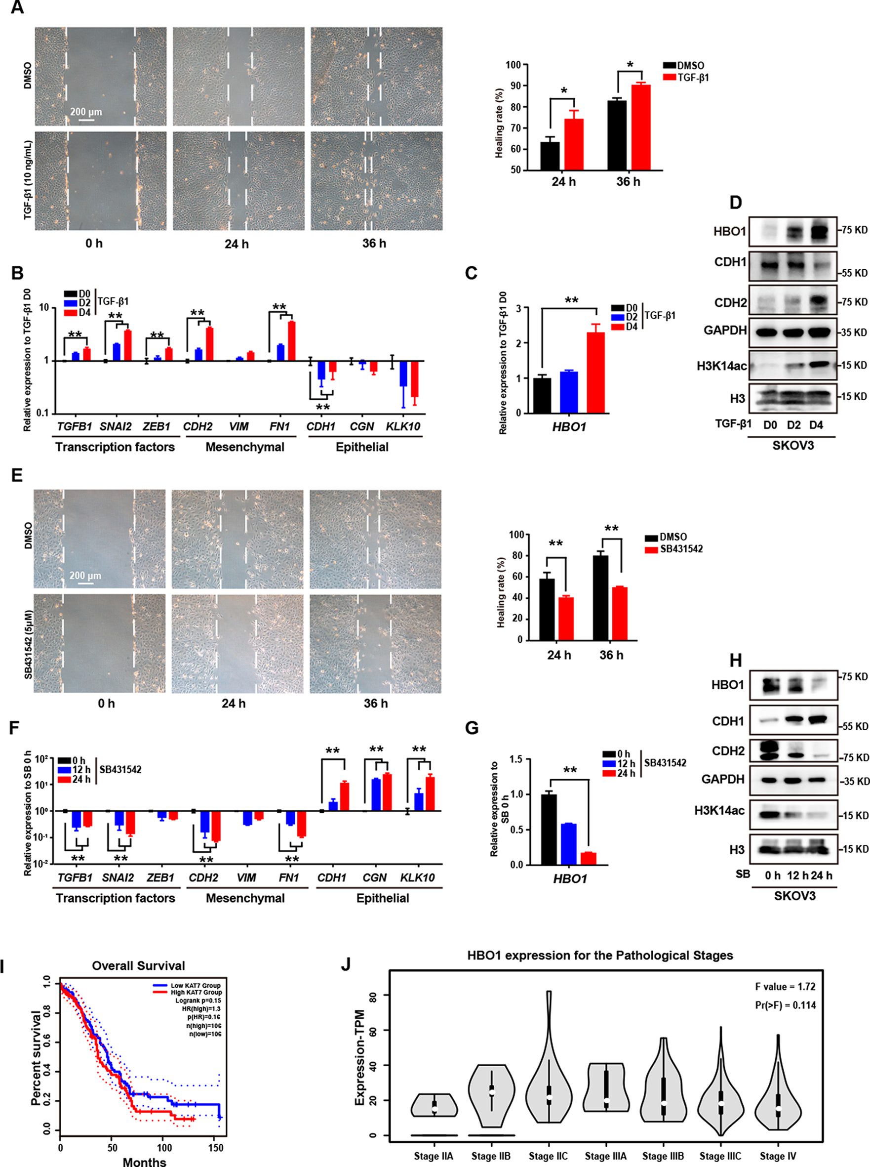HBO1 determines epithelial-mesenchymal transition and promotes immunotherapy resistance in ovarian cancer cells