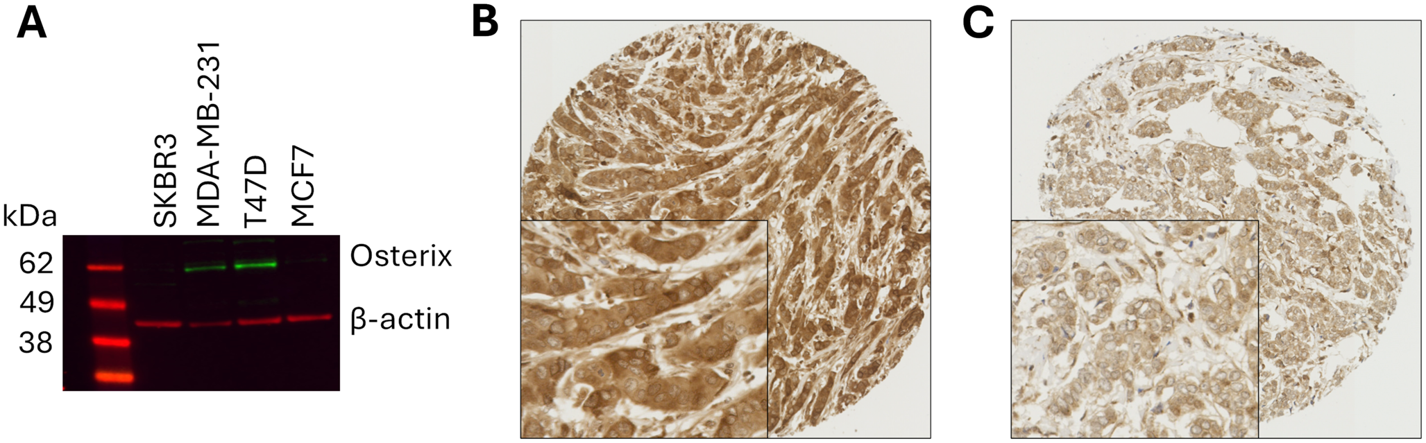 Expression of the zinc-finger transcription factor Osterix (SP7) in invasive breast cancer and its prognostic significance