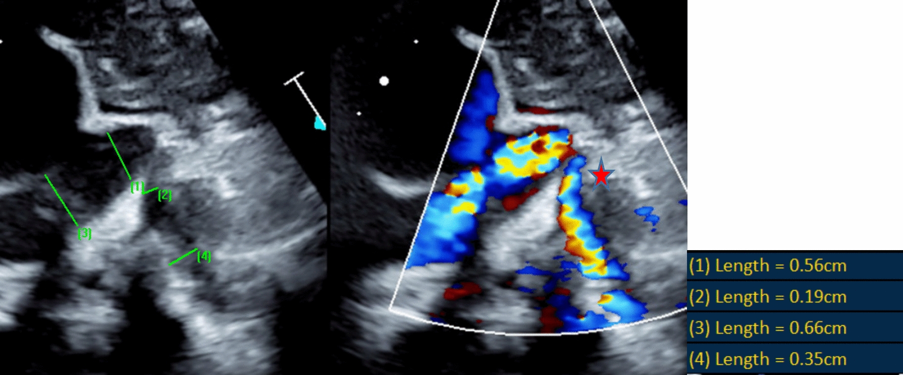 PDA Stenting May Be a Favorable Alternative to BTT Shunt Regarding Acute Complications and Mid Term Pulmonary Artery Growth