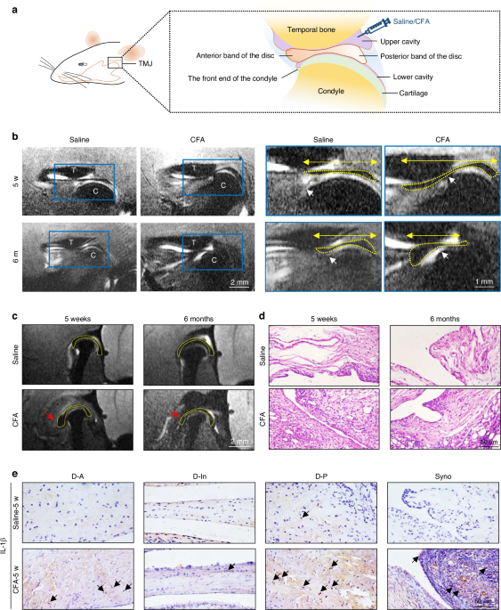 Inflammation-related collagen fibril destruction contributes to temporomandibular joint disc displacement via NF-κB activation