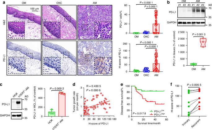 Programmed death-ligand 1 regulates ameloblastoma growth and recurrence