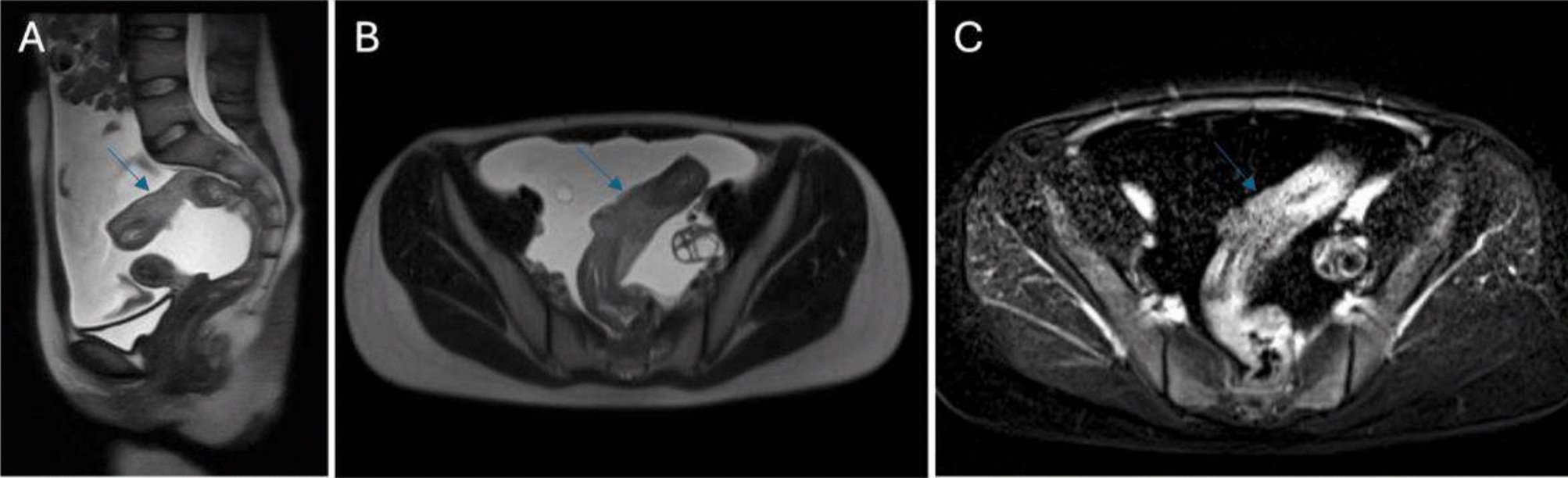 Colorectal cancer in children: an evaluation of the existing literature based on the 11-year experience of a single center