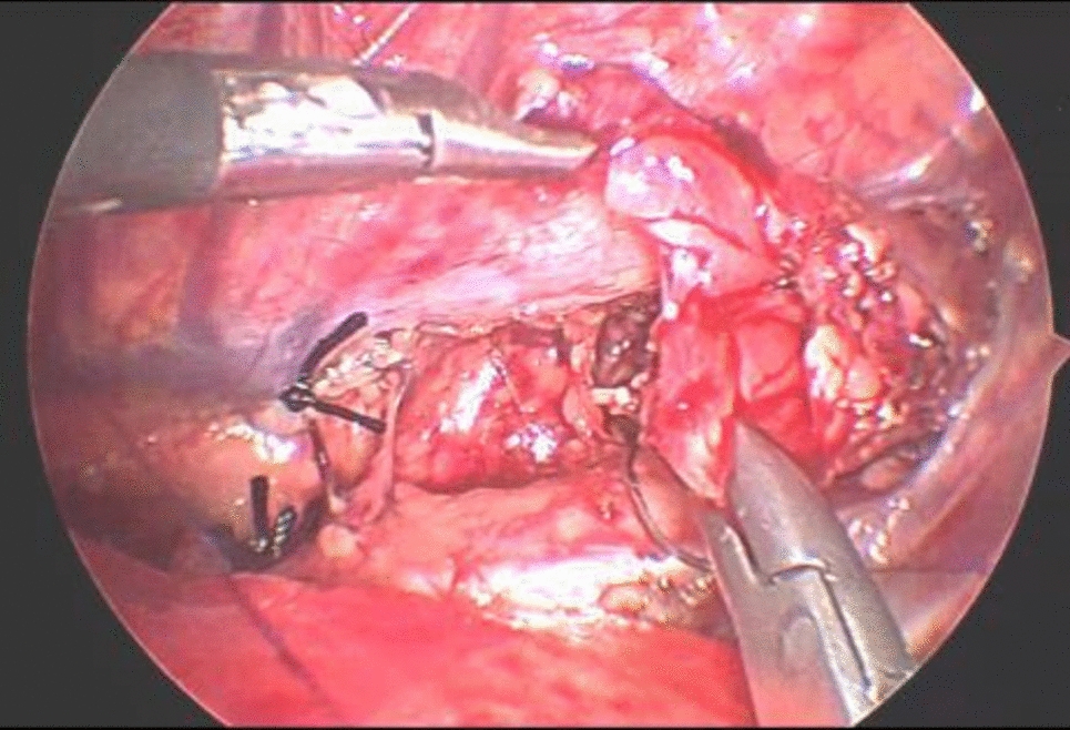 Continuous clamping facilitates distal fistula dissection in thoracoscopic repair of type C esophageal atresia: a novel surgical technique