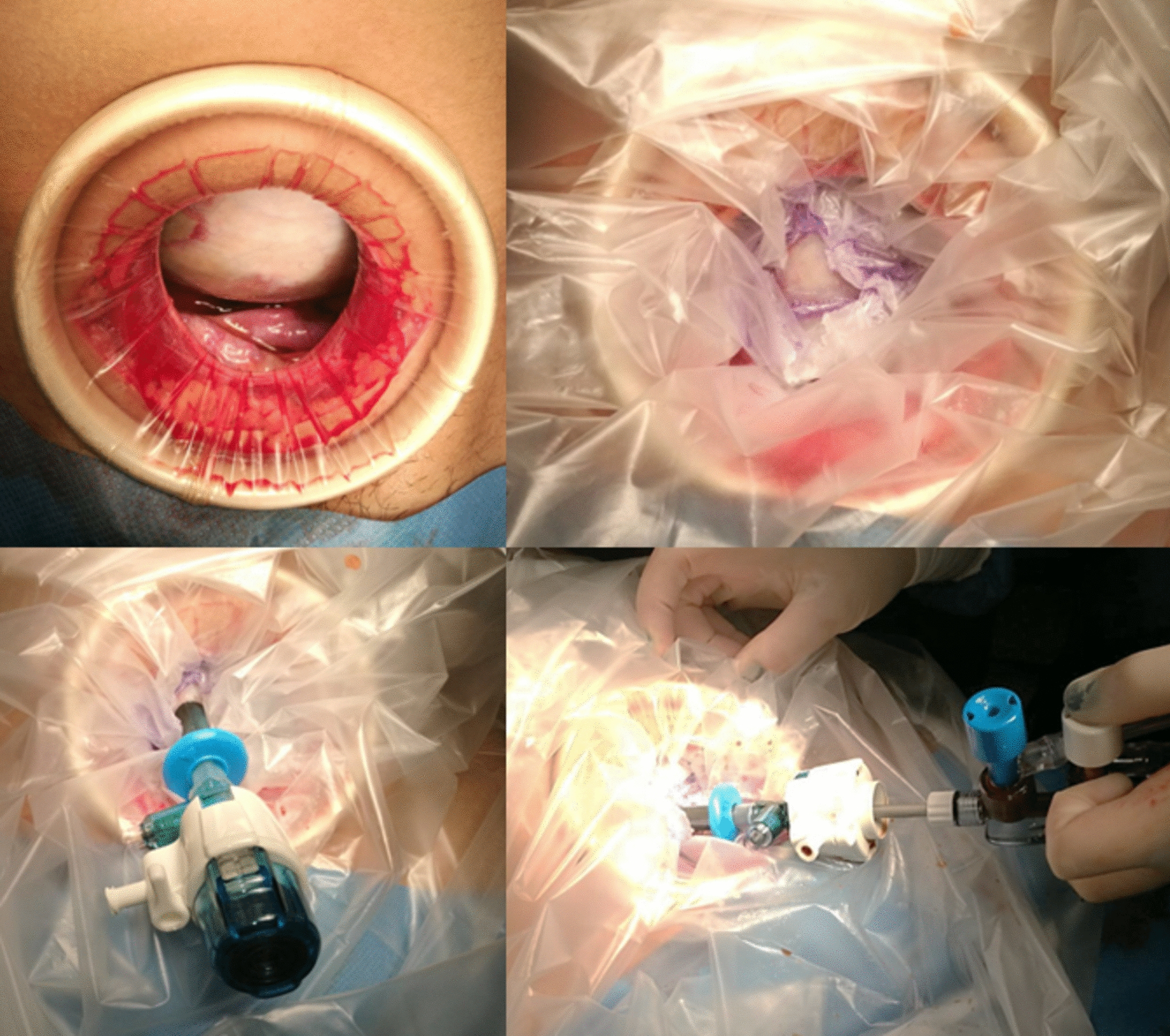 Direct balloon trocar technique for closed decompression of large predominantly cystic ovarian tumors in adolescents
