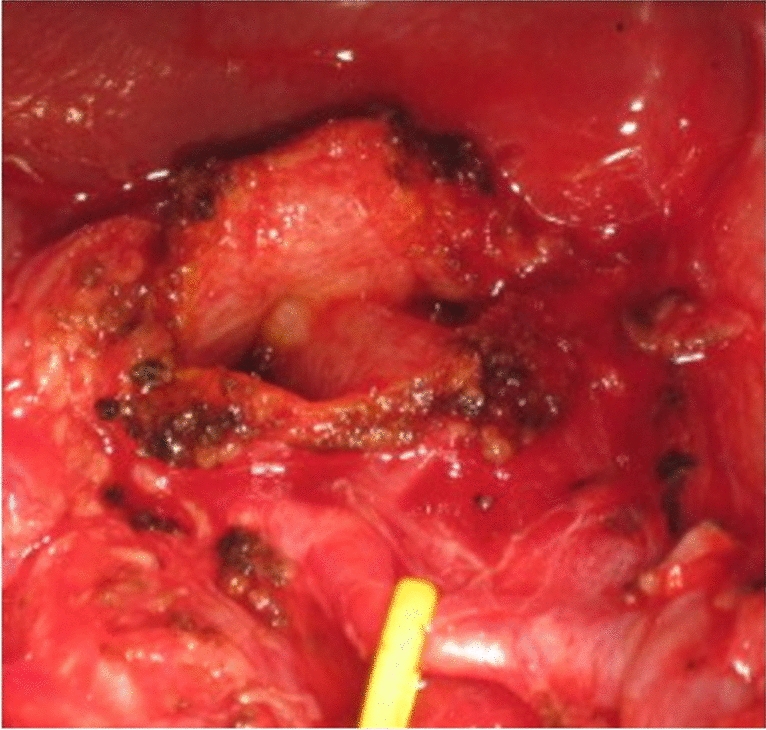Appropriate excision surgery reduces intrahepatic bile duct dilatation in pediatric patients with congenital biliary dilatation