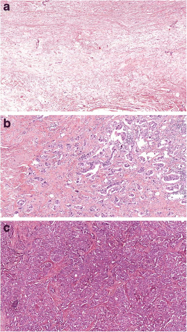 Examination of Tumor Regression Grading Systems in Breast Cancer Patients Who Received Neoadjuvant Therapy