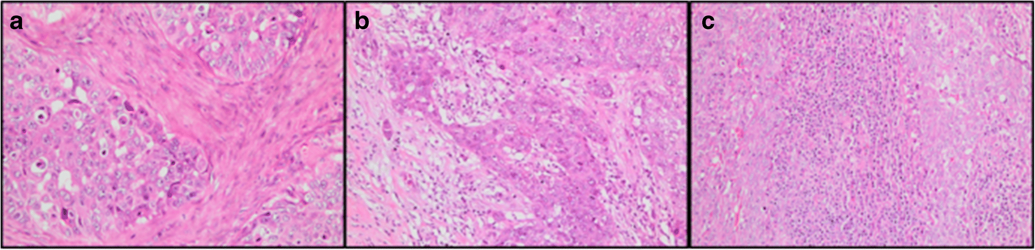 Prognostic Role of Immune Markers in Triple Negative Breast Carcinoma