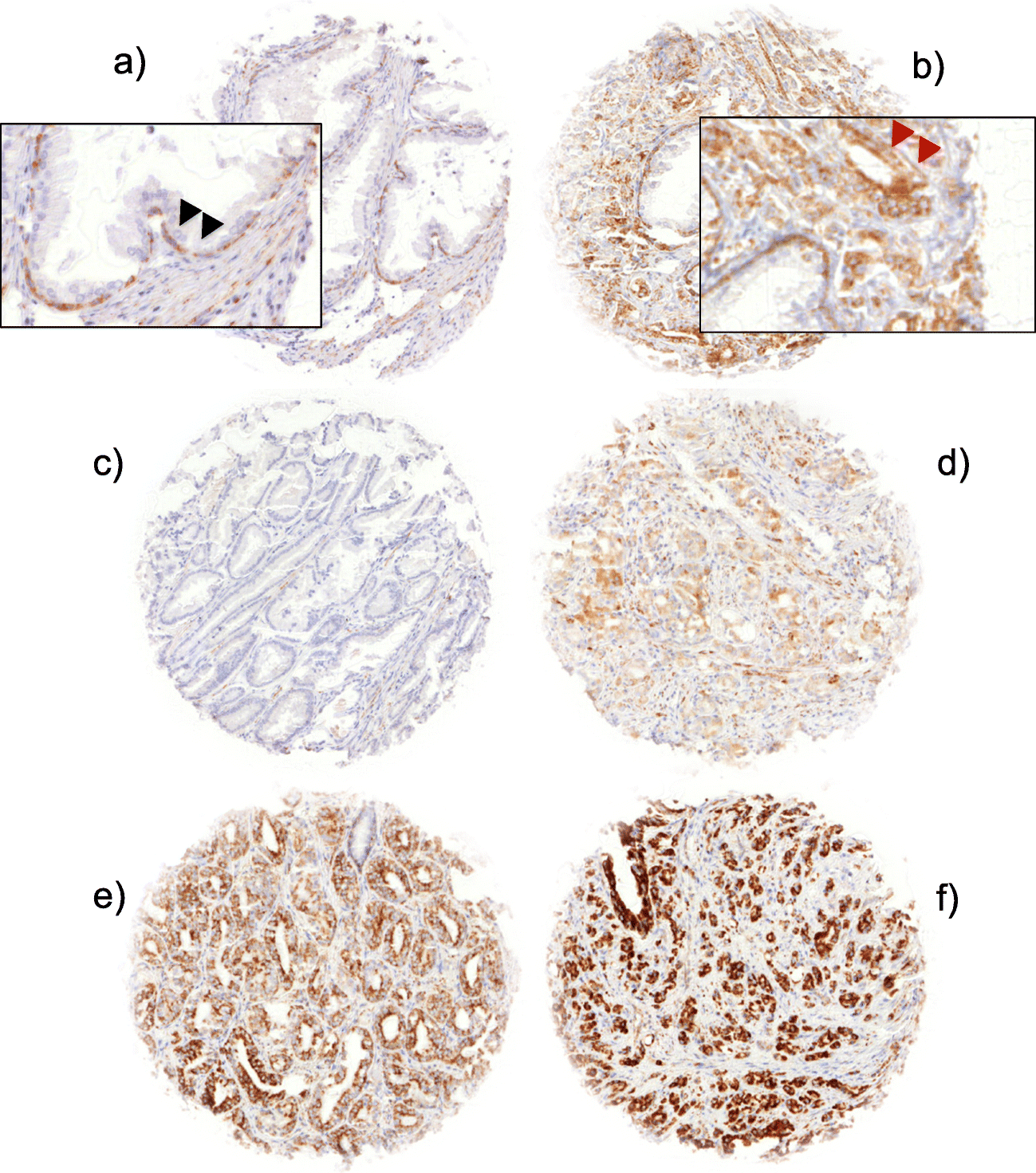 Secreted Frizzled-Related Protein 4 (SFRP4) Is an Independent Prognostic Marker in Prostate Cancers Lacking  Fusions