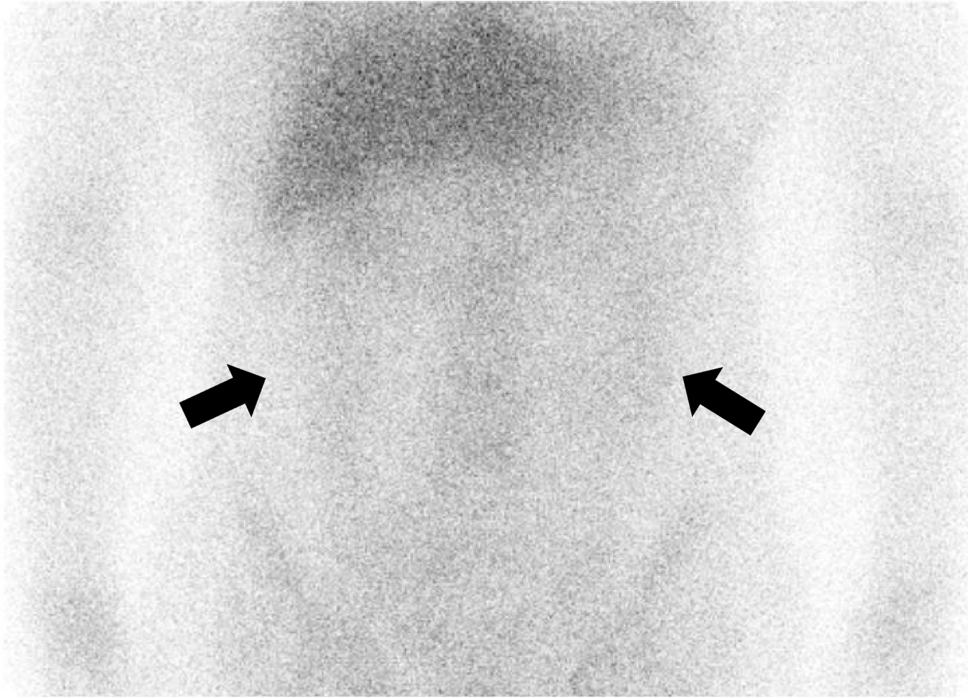 Tubular damage and SGLT2 expression in a patient with Beni-koji tablet-associated acute kidney injury and Fanconi syndrome