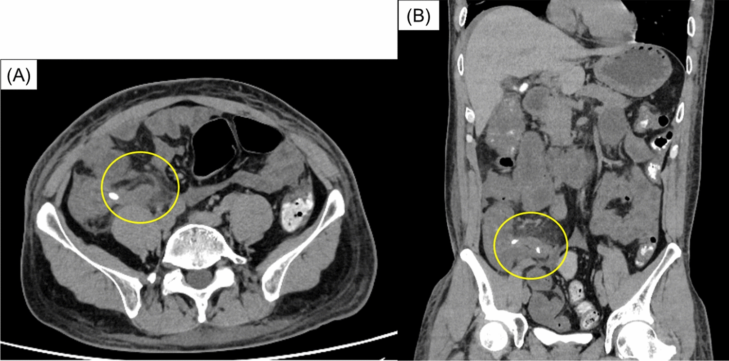 A case of acute appendicitis in a patient with minimal change disease