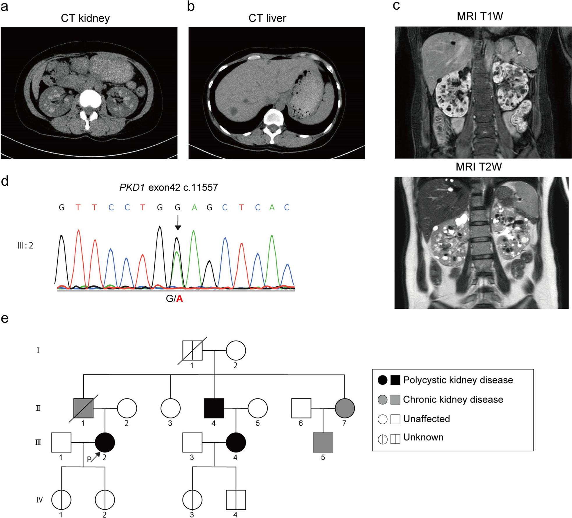 Genetic and protein structure prediction analyses identify a rare pathogenic  variant causing autosomal dominant polycystic kidney disease