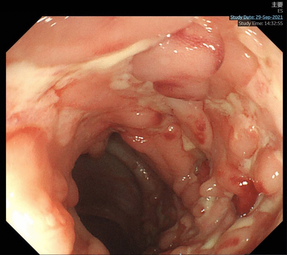 IgA nephropathy and IgA vasculitis in a pediatric Crohn’s disease patient with early IgA deposition in vascular walls of intestines
