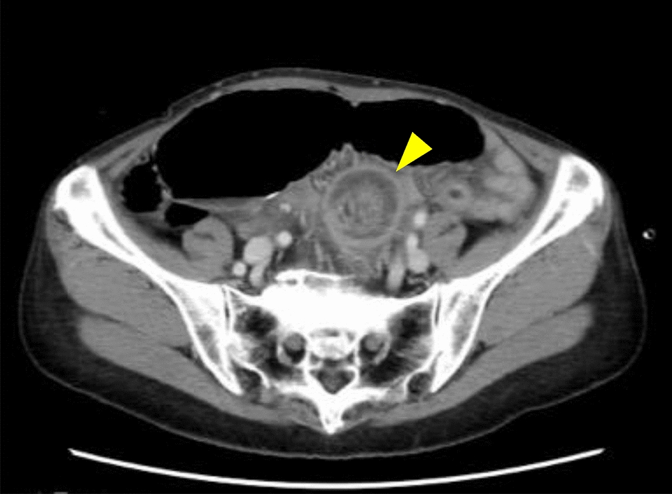 Avoiding unnecessary bowel resection in adult intussusception: a case report in a patient with multiple prior surgeries utilizing intraoperative enteroscopy