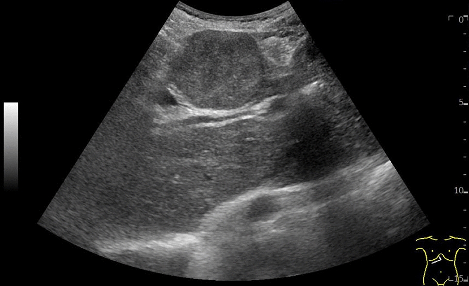 Spontaneous rupture of hepatocellular carcinoma in Fontan-associated liver disease with fatal outcome: case report and literature review