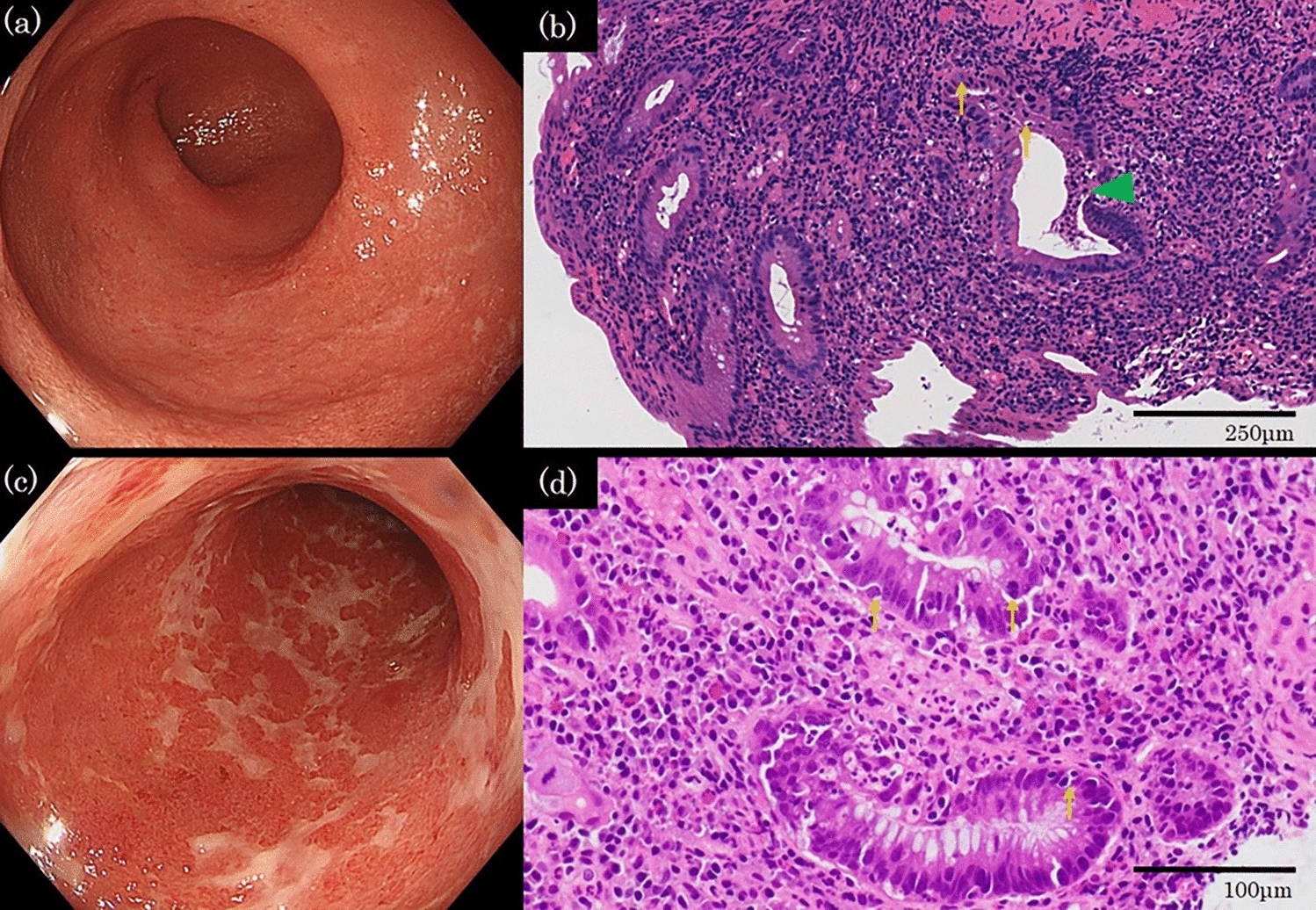 Relapsed refractory immune checkpoint inhibitor-induced colitis treated with tacrolimus and maintained with vedolizumab