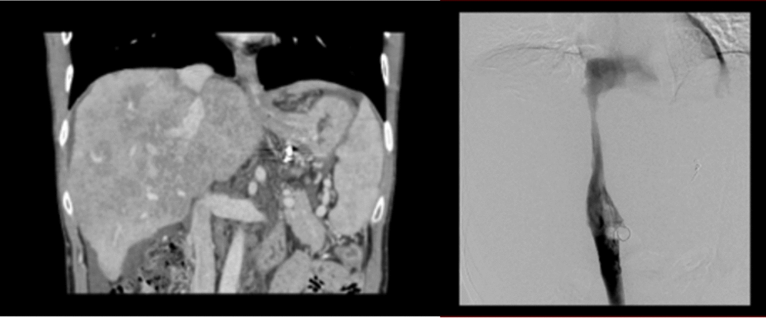 A case of Budd-Chiari syndrome with acute venous thrombosis and liver failure: highlighting the importance of early intervention and anticoagulation therapy