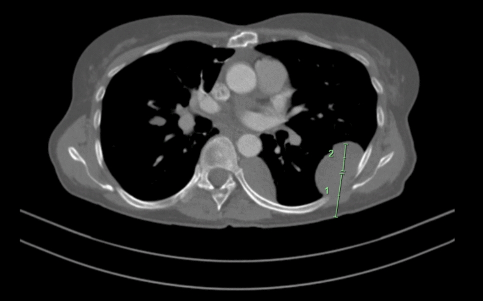 Intestinal failure from thymoma-associated autoimmune enteropathy: a rare case report