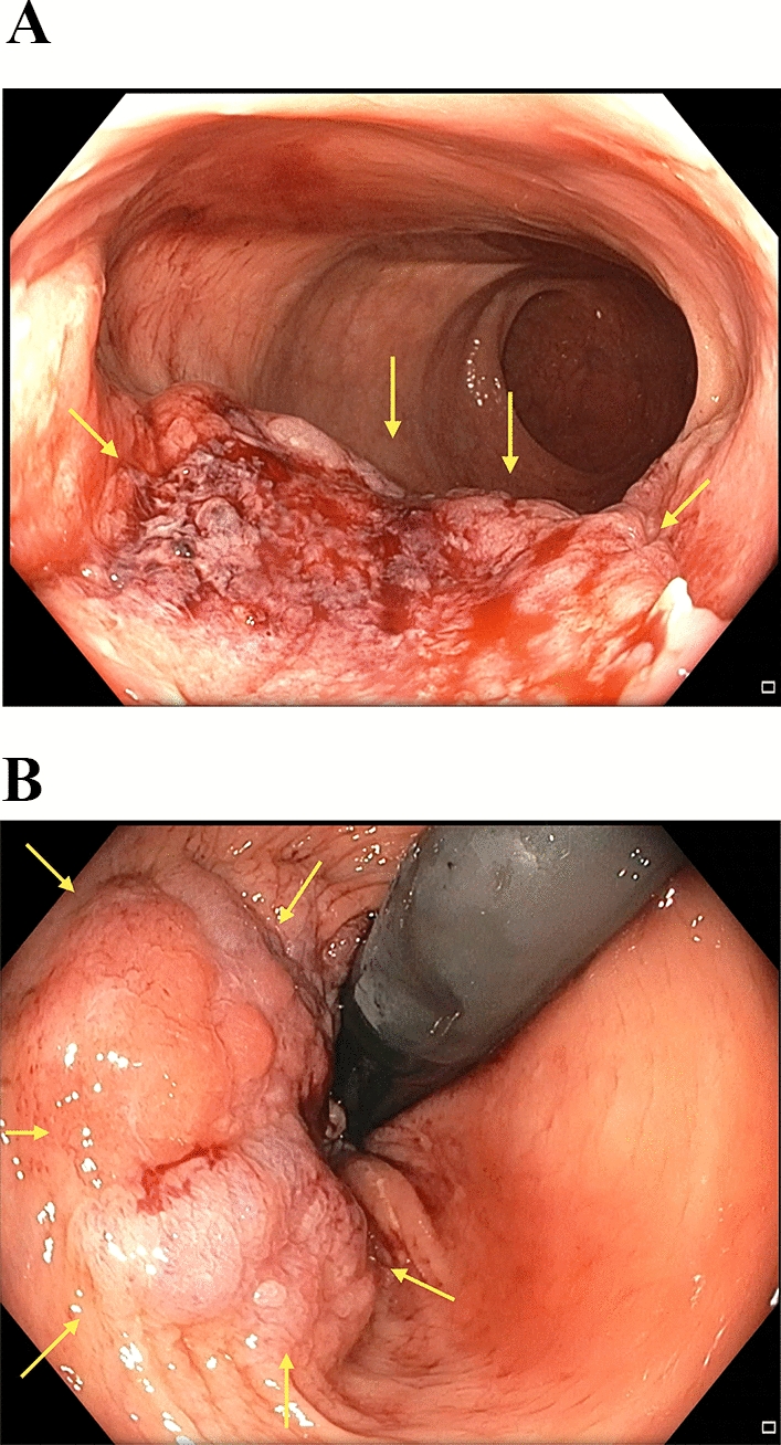 The Landmark Series: Organ Preservation in Rectal Cancer—The Watch and Wait Strategy