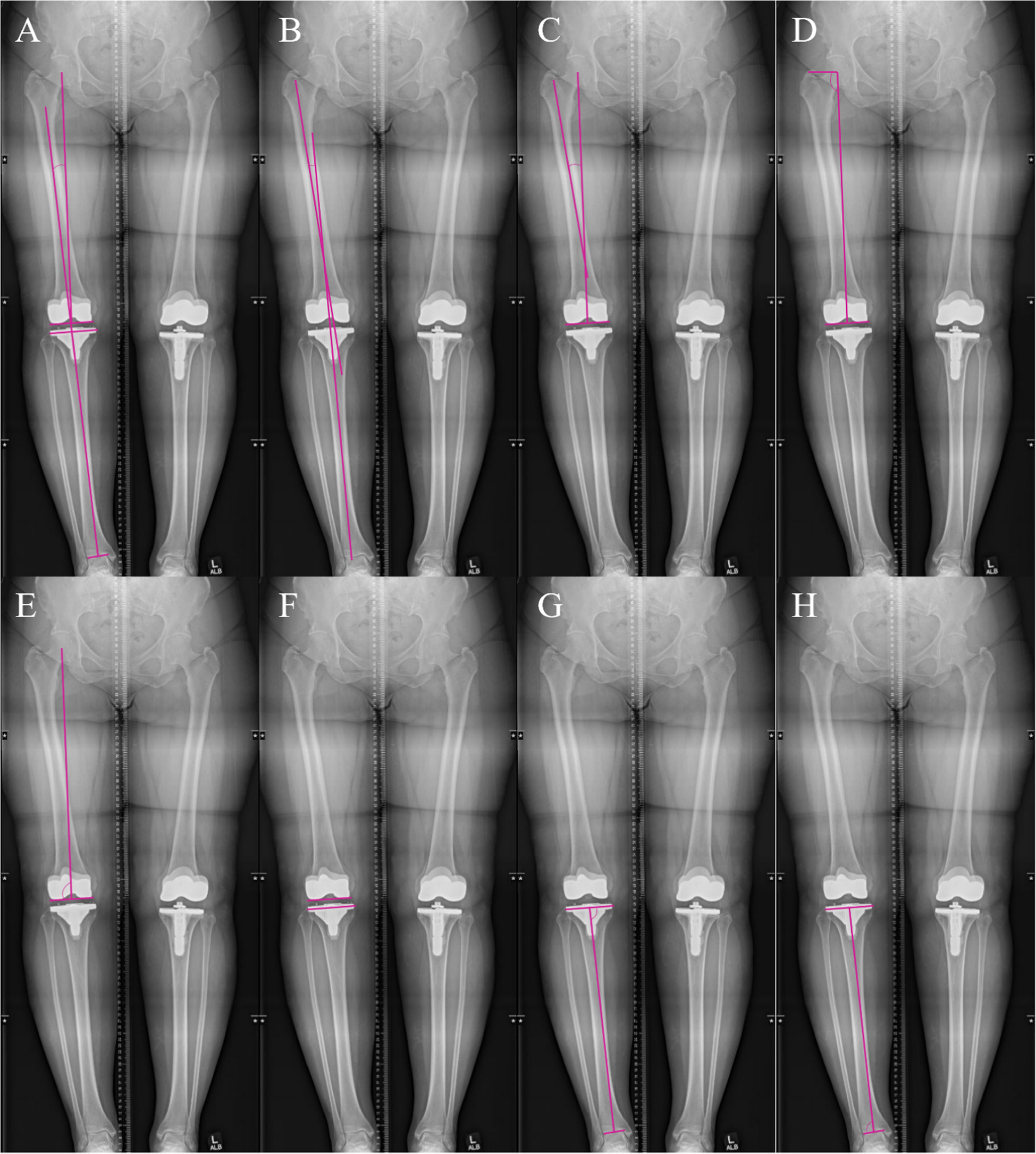 Are artificial intelligence generated lower extremity radiographic measurements accurate in a cohort with implants?