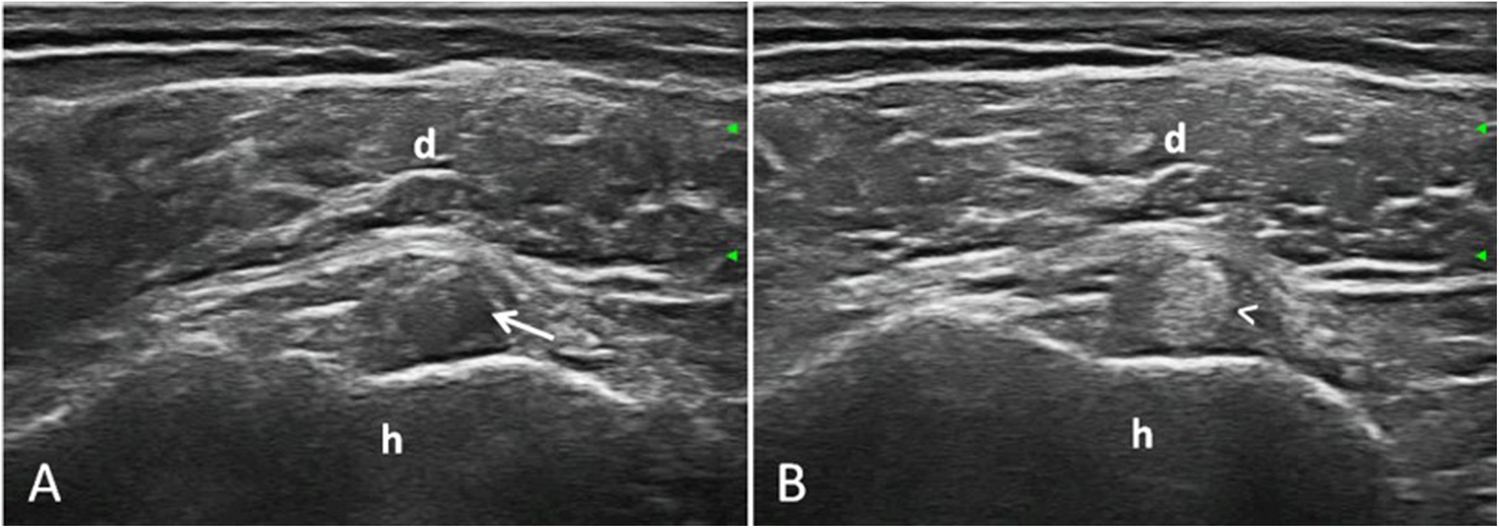 B-mode artefacts relevant in rheumatological musculoskeletal ultrasound—impact on image interpretation and their diagnostic value