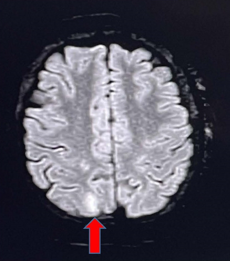 Posterior Reversible Leukoencephalopathy Syndrome During Hypertensive Crisis in Obstructive Sleep Apnea Syndrome: Searching for a Link