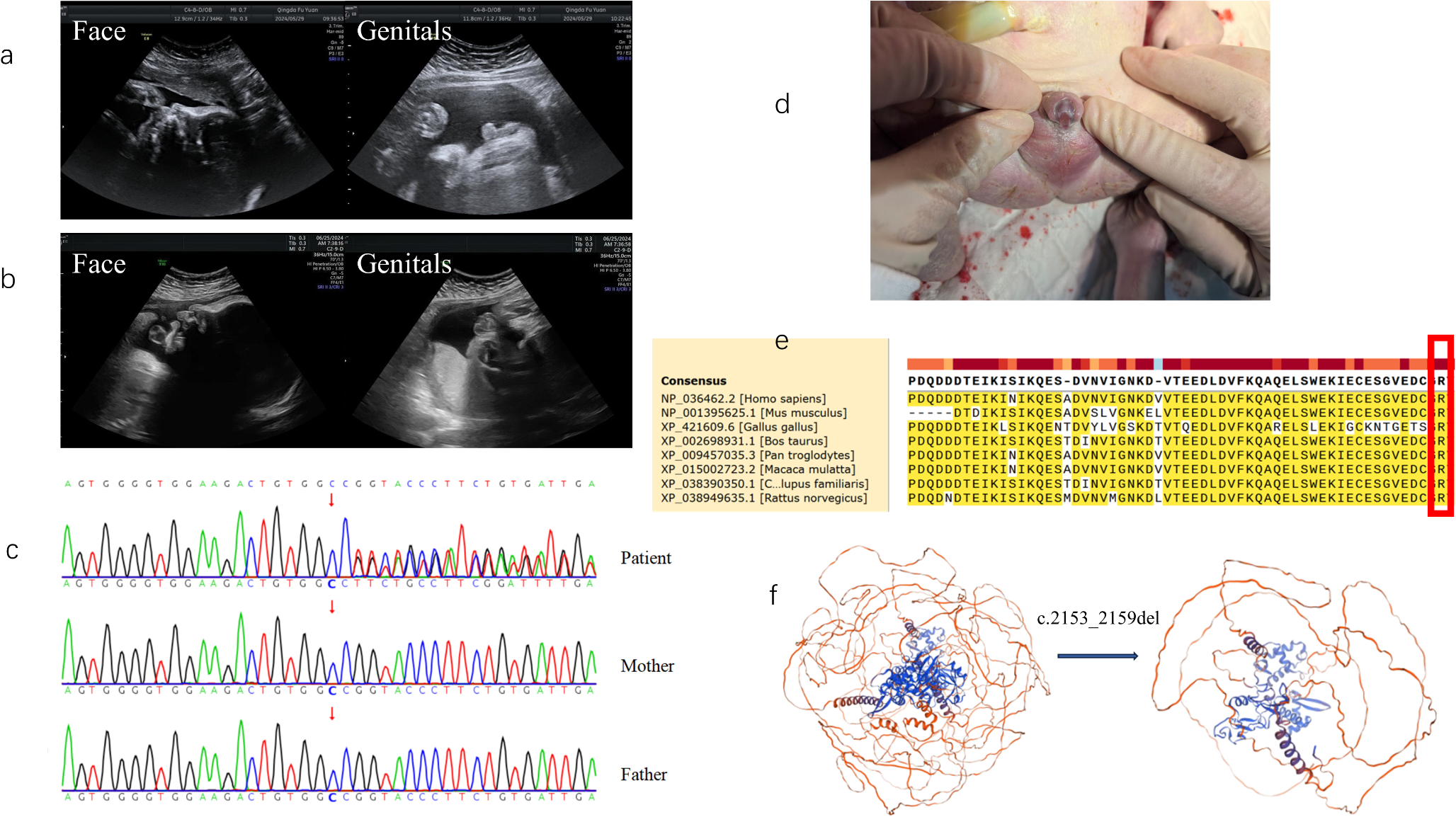 A Novel  Mutation Causes Hypospadias in a Chinese Fetus at 29 Weeks Gestation
