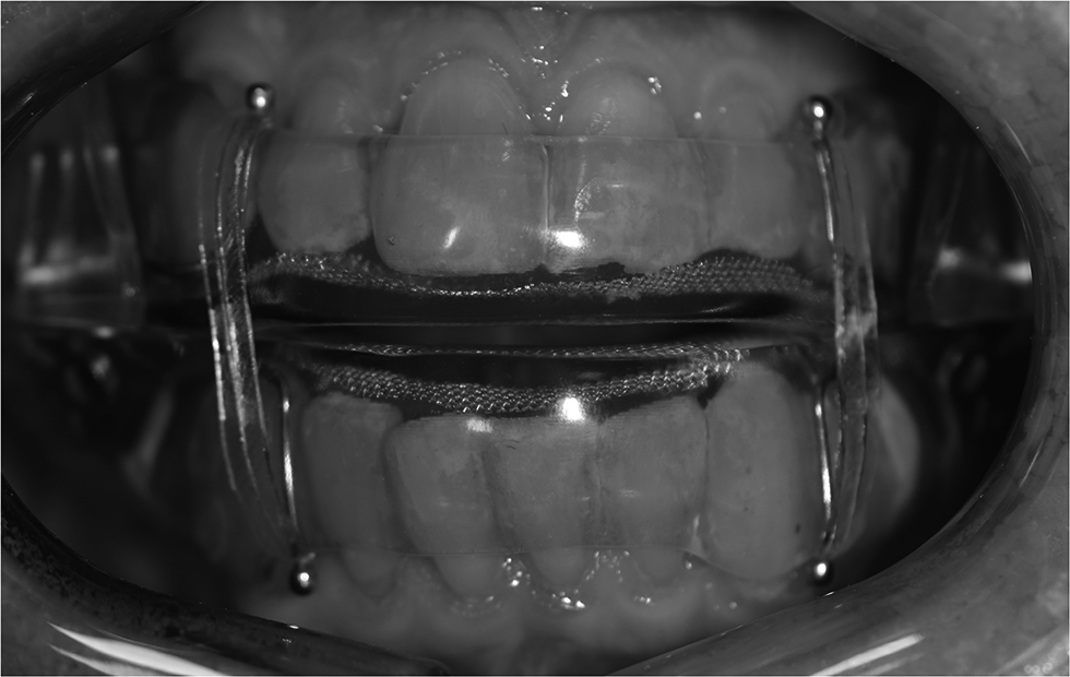 Prediction of non-responders to oral appliance treatment of obstructive sleep apnea: a pilot study