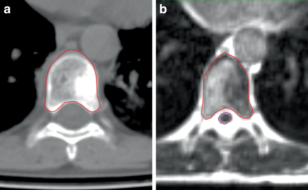 Initial experience with MR-guided adaptive spinal stereotactic radiotherapy: a new indication for the MR-linac