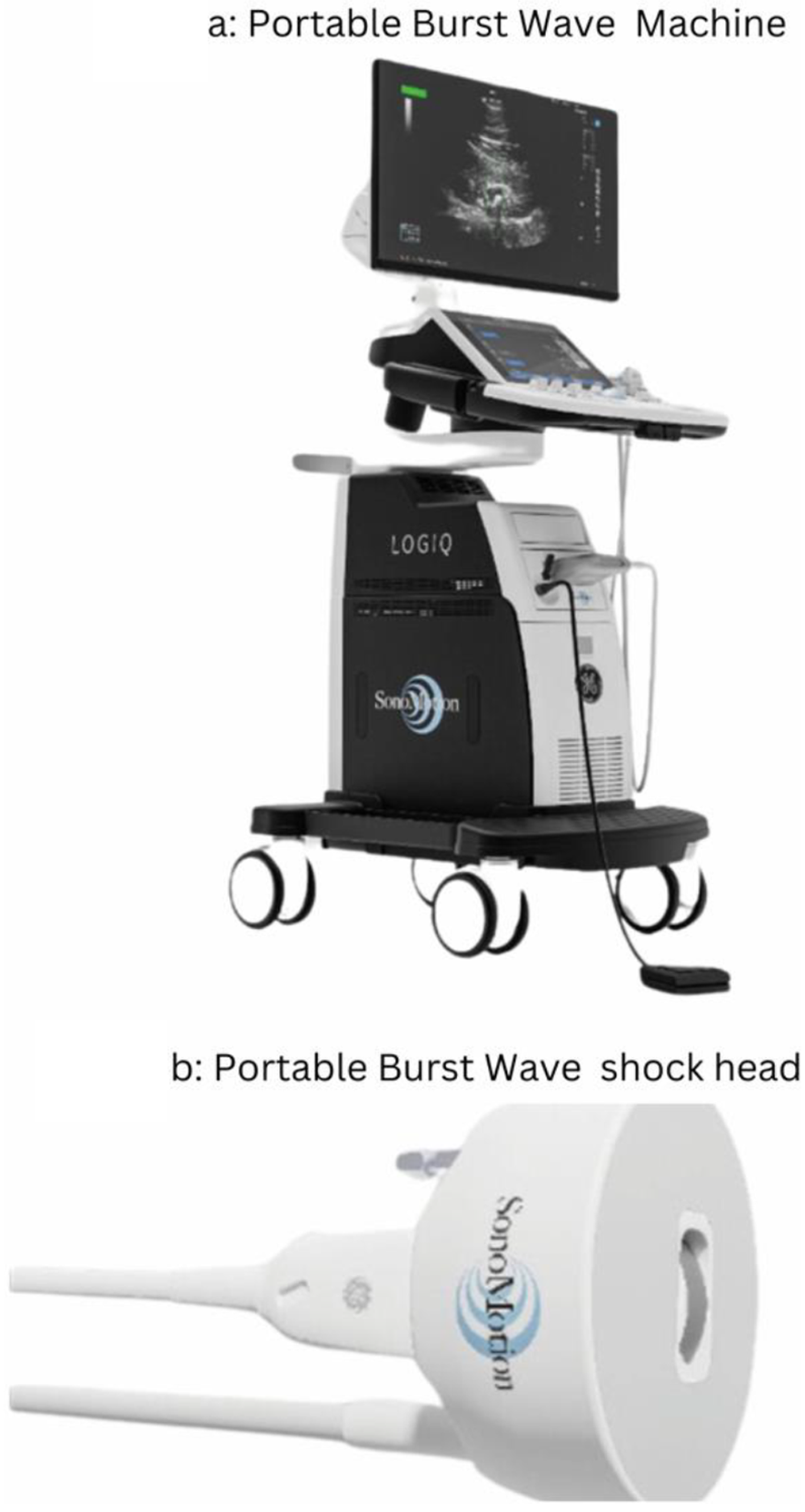 Burst wave lithotripsy - a paradigm shift: inferences from a scoping review