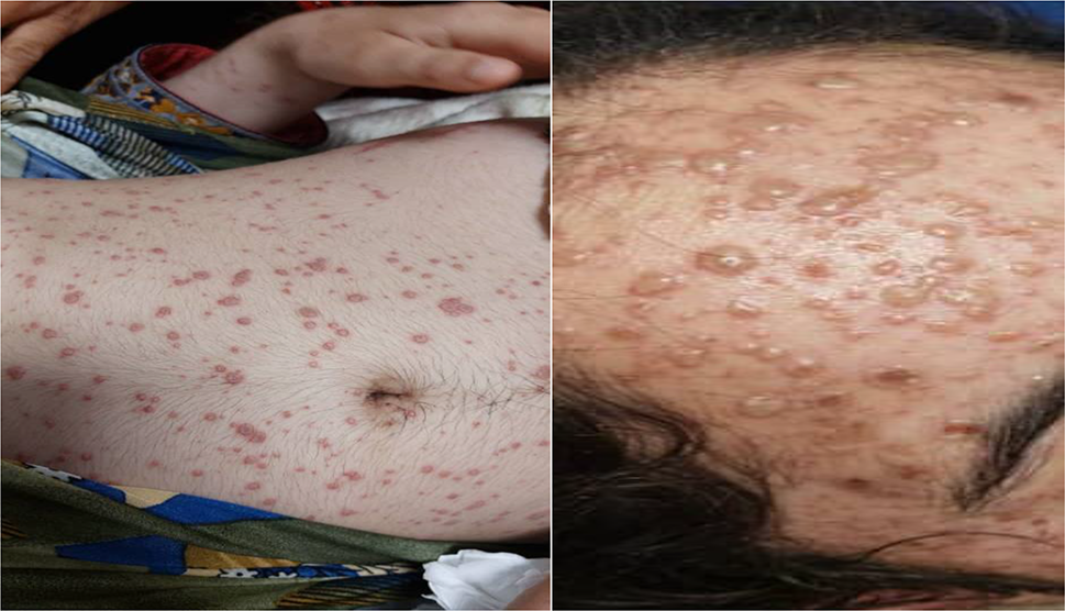 Fulminant hepatitis and multi-organ failure following varicella zoster virus infection in an adult with G6PD deficiency: a case report