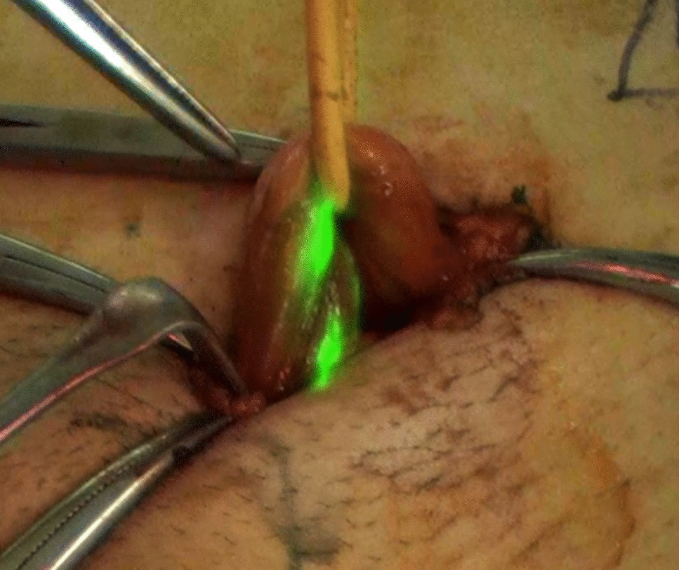 Indocyanine Green Fluorescent Lymphography During Open Inguinal Hernia Repair: Relationship Between Lymphatic Vessel Injury and Postoperative Hydrocele
