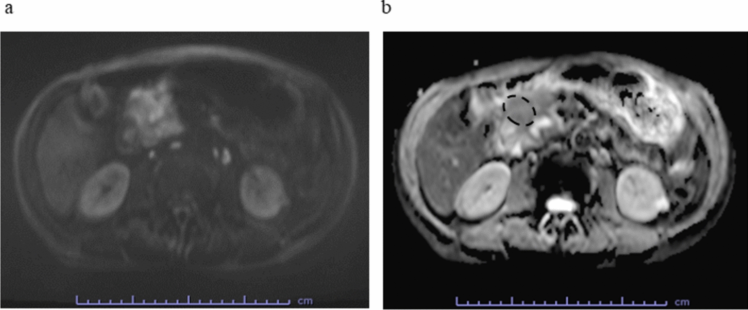 The minimum apparent diffusion coefficient value on preoperative magnetic resonance imaging in resectable pancreatic cancer: a new prognostic factor for biologically borderline resectable pancreatic cancer