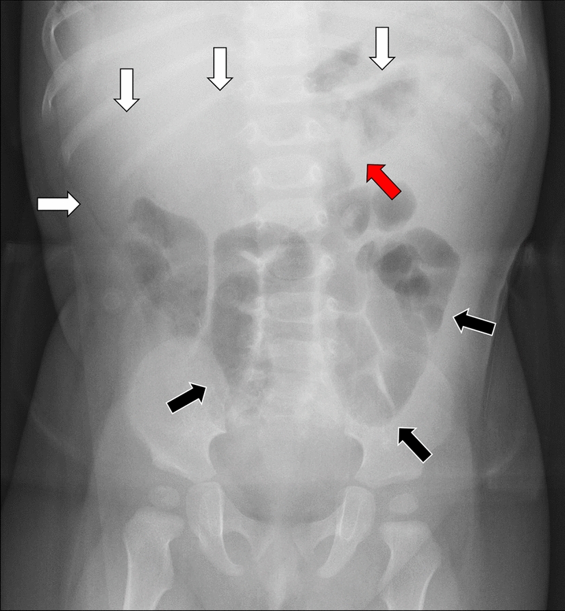 Simplified predictive model for intussusception in children: combining radiographic and clinical features