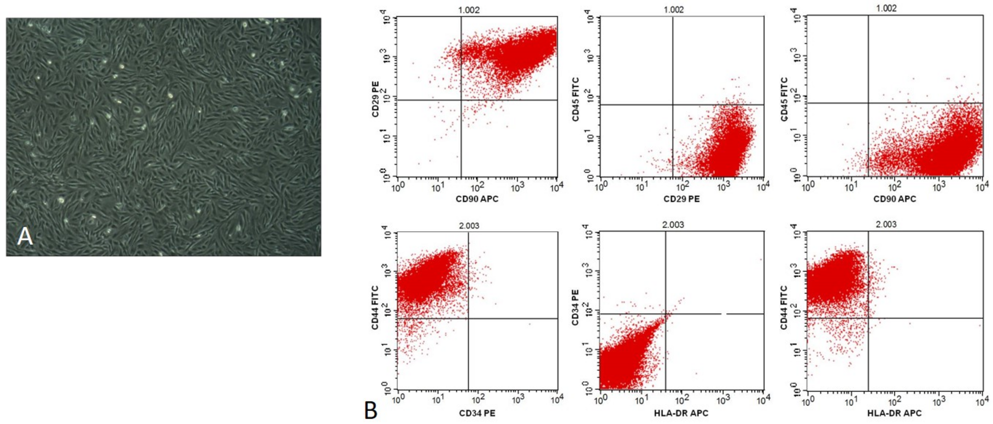 Intrauterine infusion of autologous endometrial stem cells for the treatment of moderate and severe intrauterine adhesions: a before-and-after study