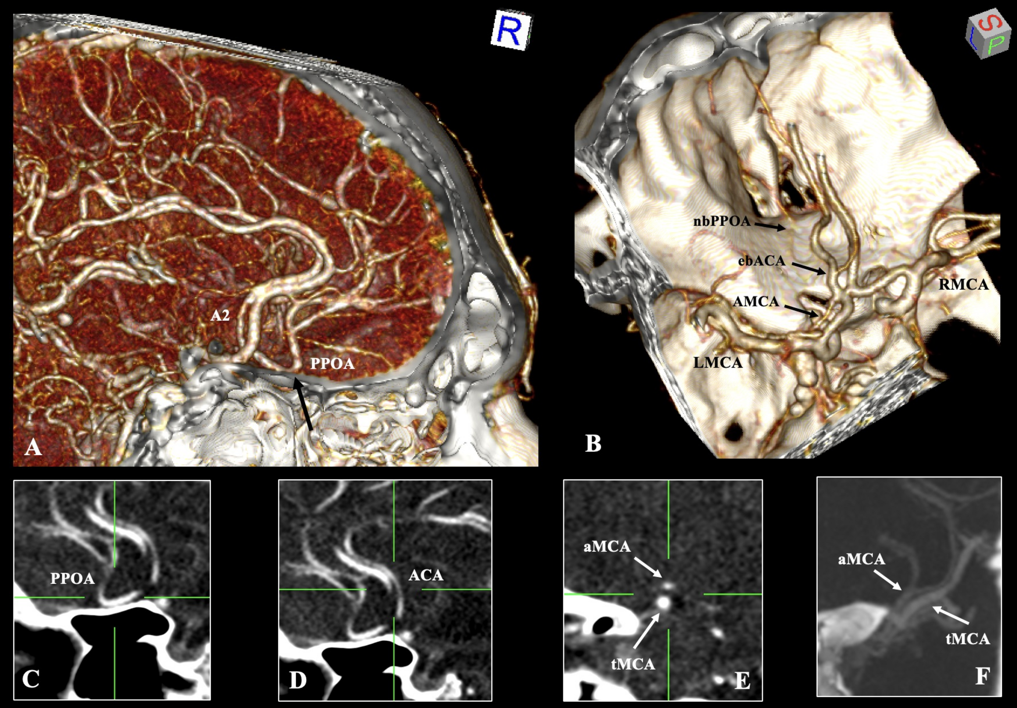 Concomitance of persistent primitive olfactory artery, accessory middle cerebral, and early bifurcated anterior cerebral arteries