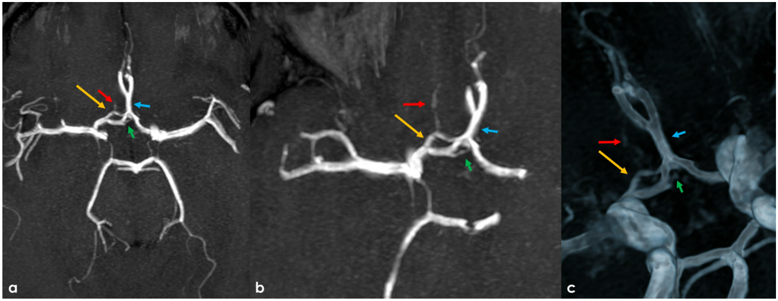 Dual fenestration of the A1 and azygos A2 segments of the anterior cerebral artery illustrated by Magnetic Resonance Imaging