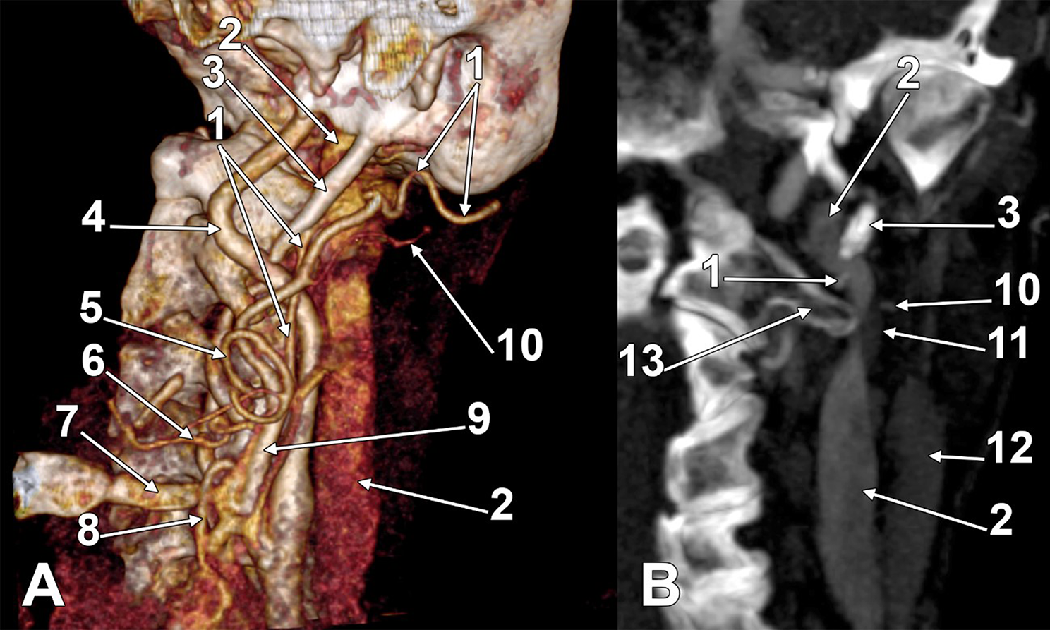 Aberrant courses of the occipital artery
