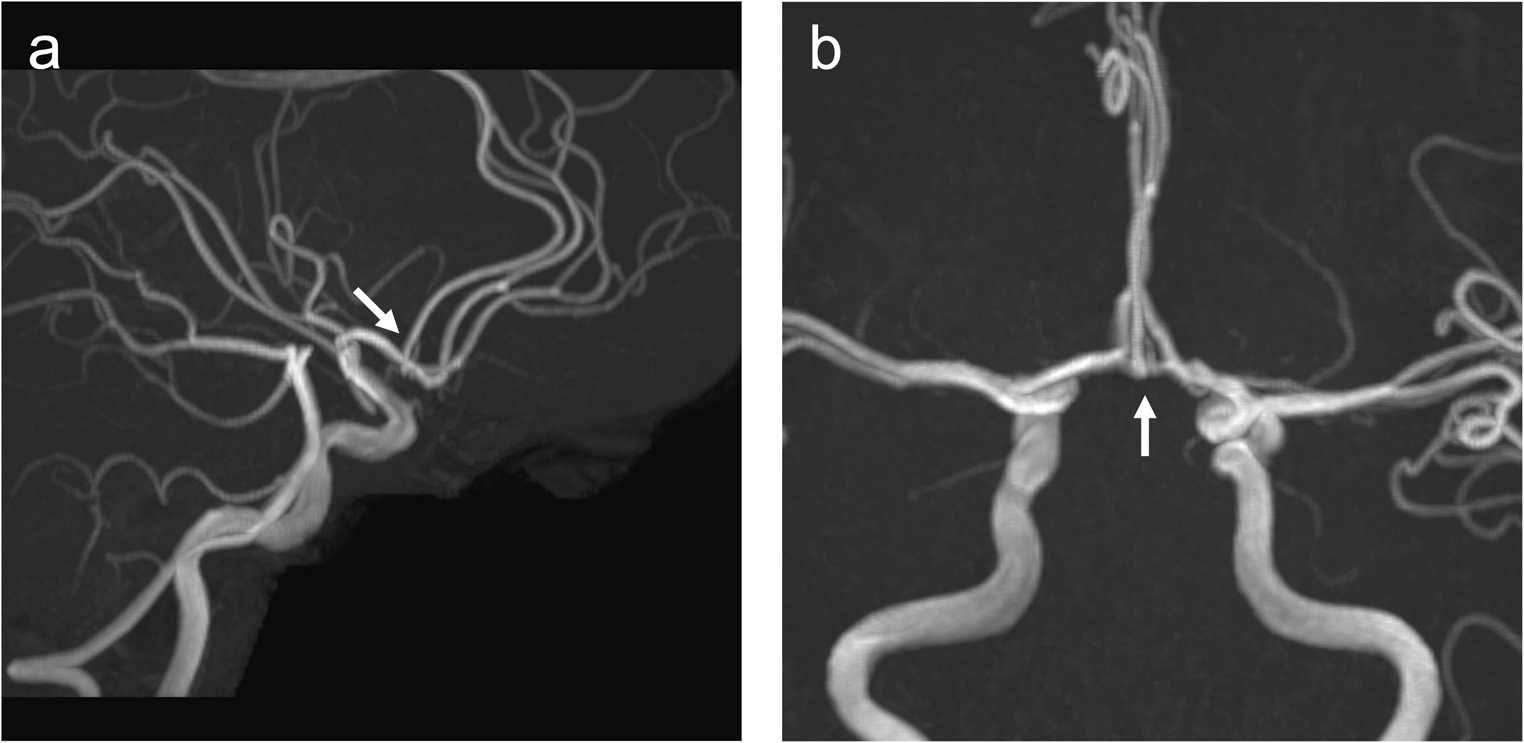 Accessory anterior cerebral artery of duplicate origin associated with accessory middle cerebral artery and anterior cerebral artery fenestration
