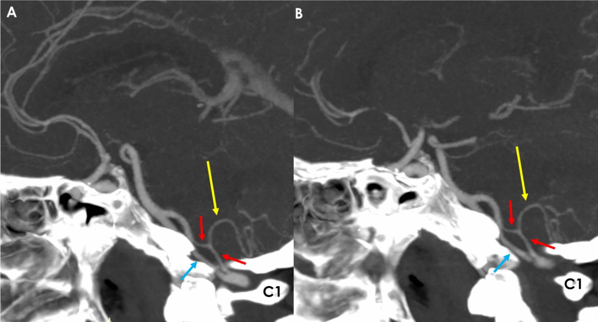 Posterior inferior cerebellar artery originating from a limb of intracranial vertebral artery fenestration: a Computed Tomography Angiography and Magnetic Resonance Angiography study