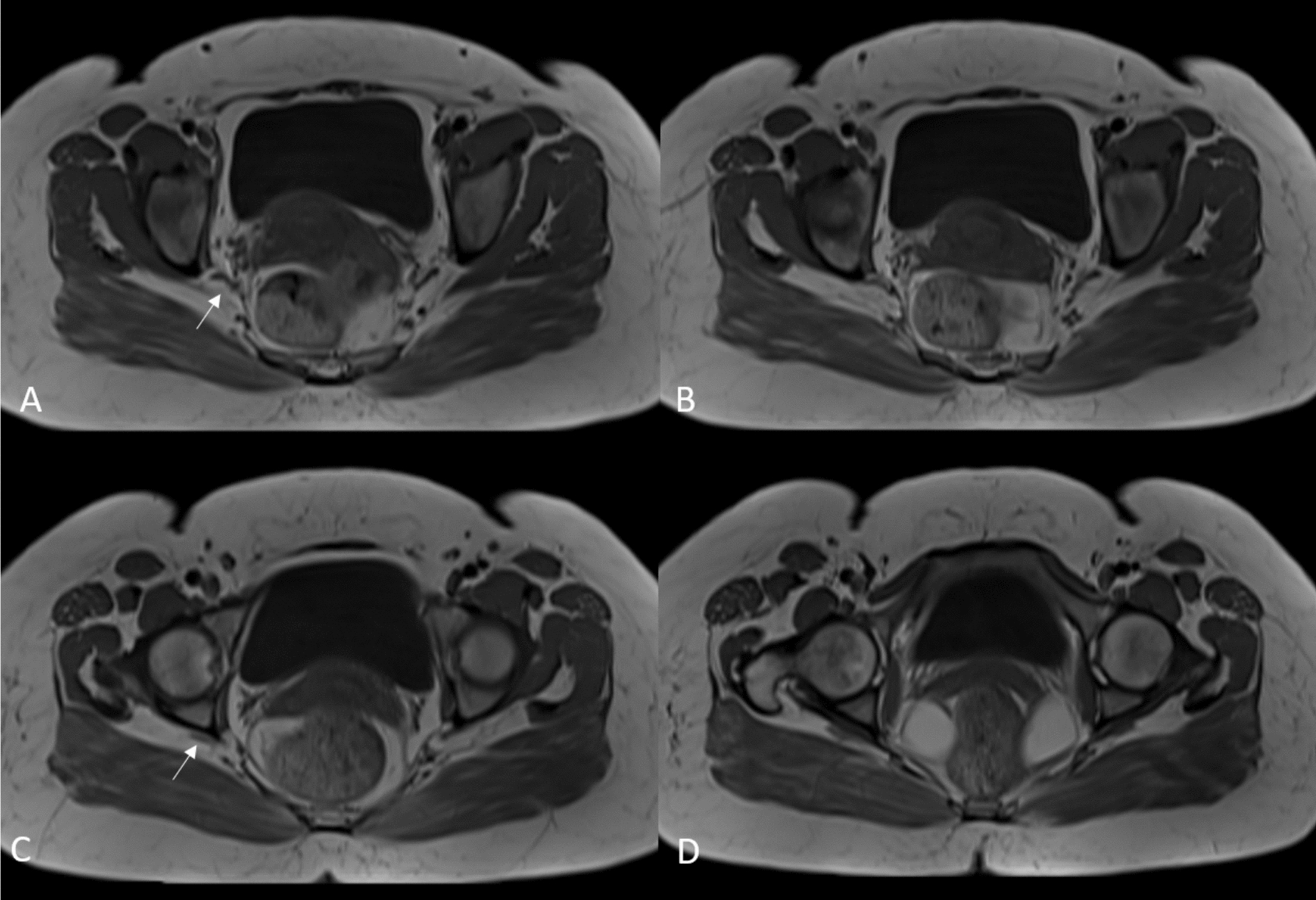 Piriformis agenesis: case reports of a rare anatomical anomaly with potential clinical impact