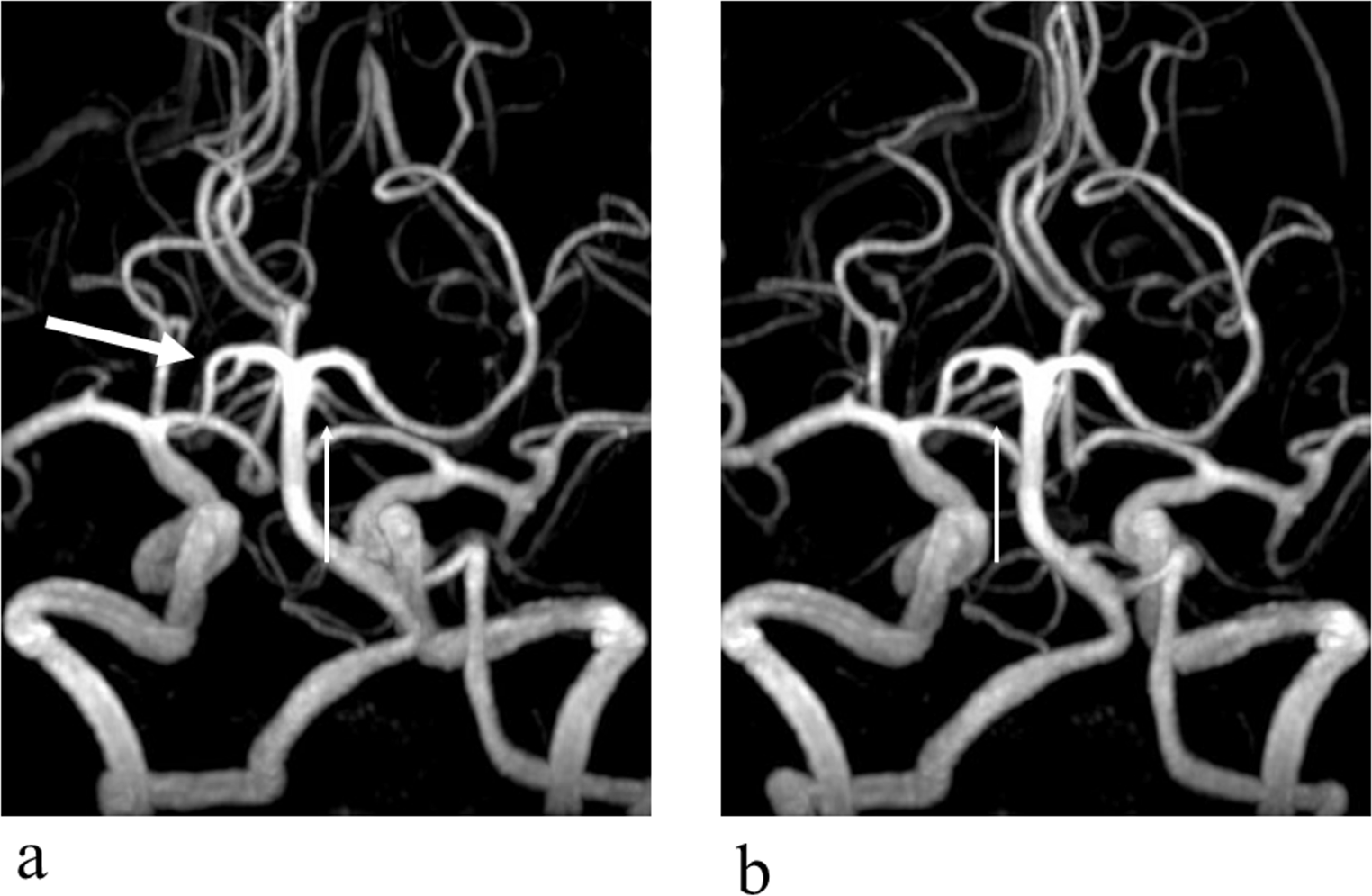 Right posterior cerebral artery fenestration coexisting with bilateral superior cerebellar artery duplications diagnosed by magnetic resonance angiography