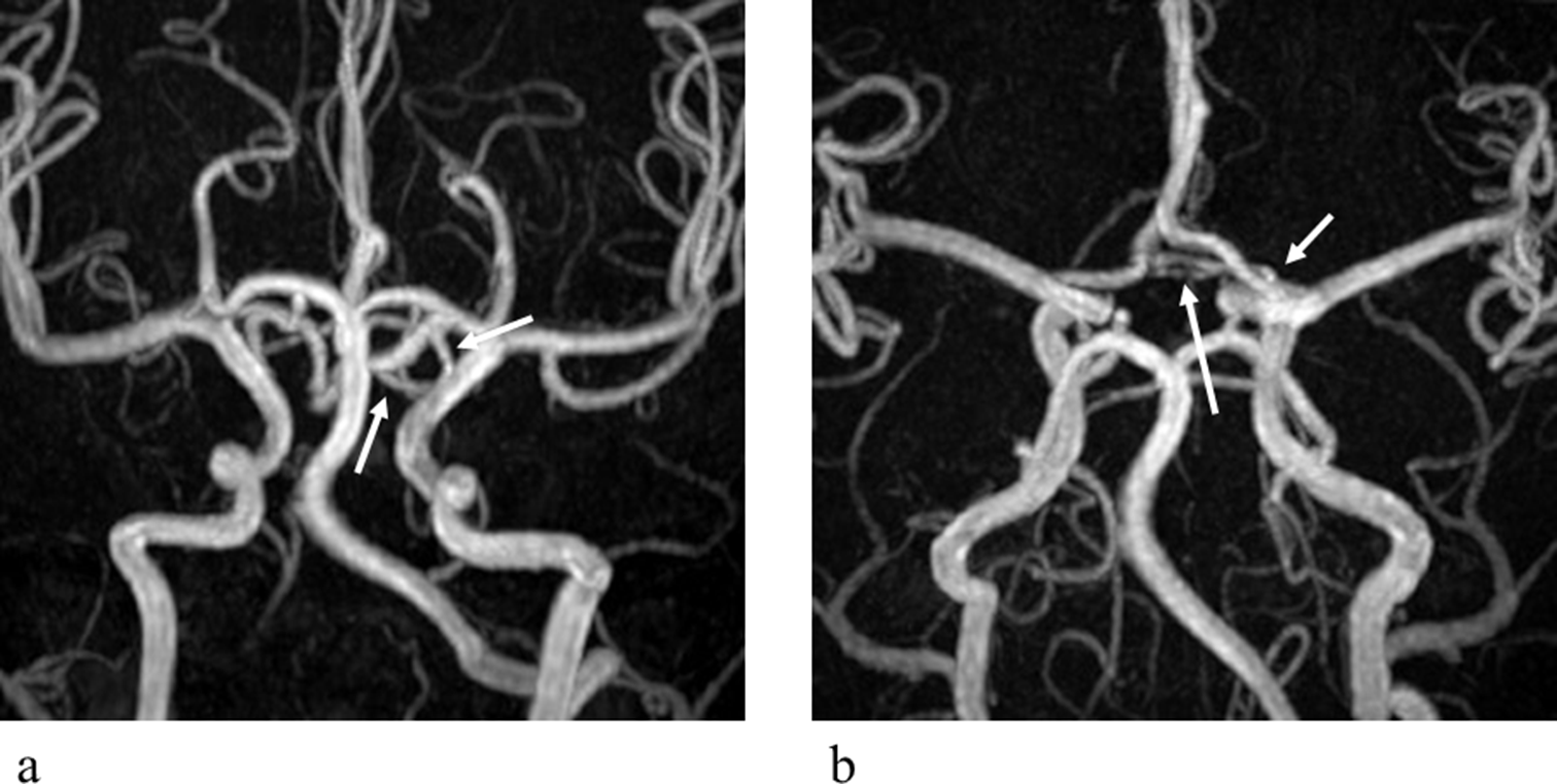 True fenestration of an extremely long anterior communicating artery diagnosed by magnetic resonance angiography