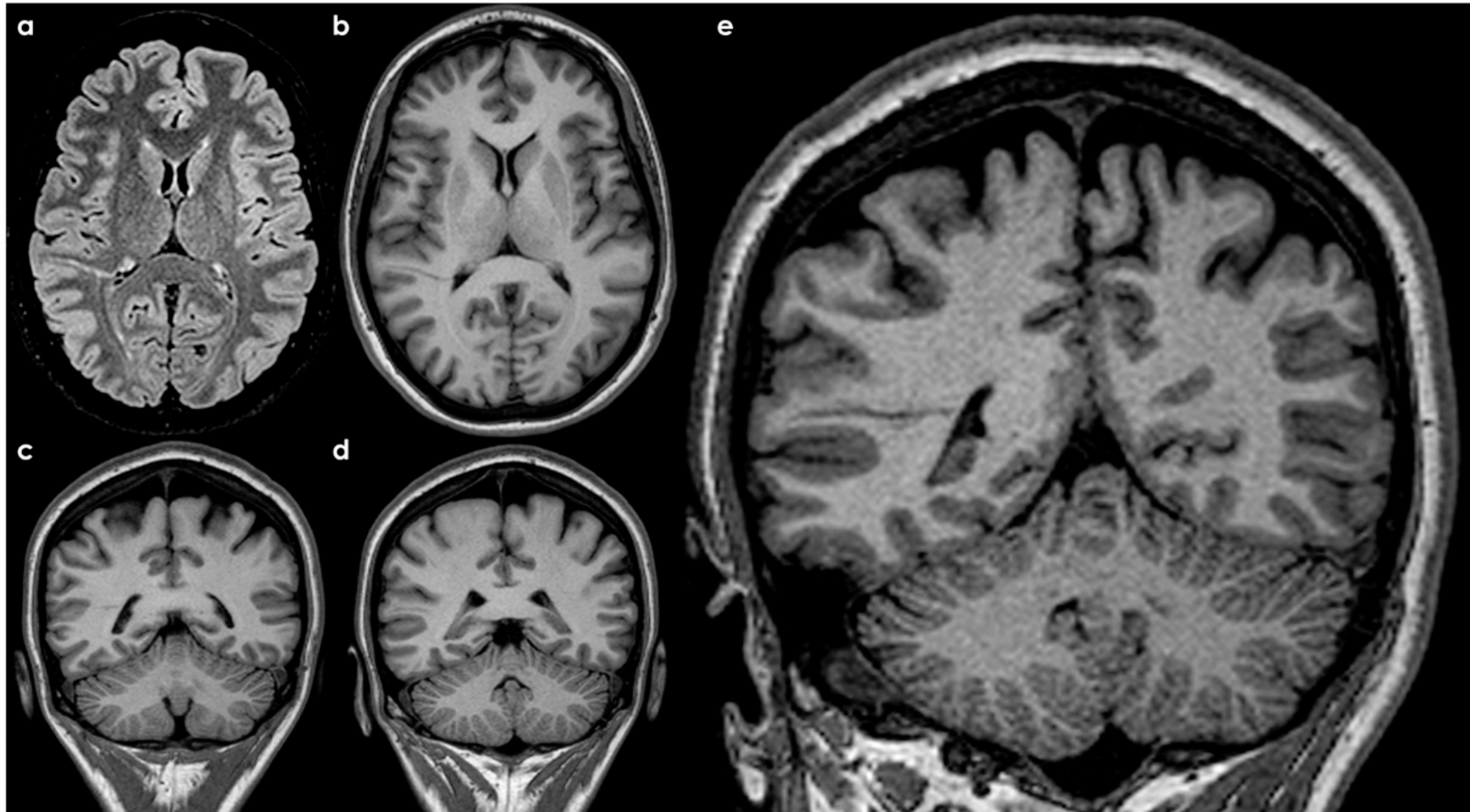 Cerebral transmantle vein on magnetic resonance imaging: an embryological pattern persisting up to the adulthood