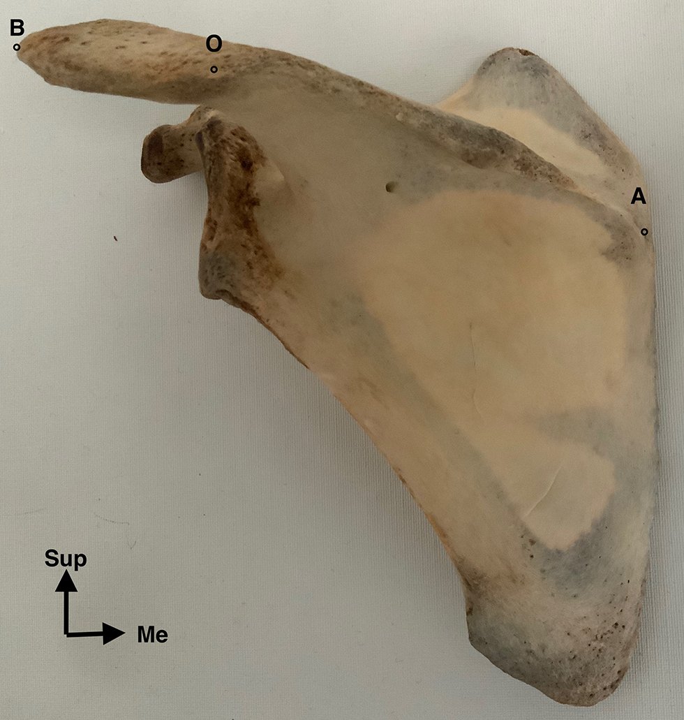 Validation of the inter‑individual variability of the angulus acromialis (acromial opening angle) and its clinical relevance