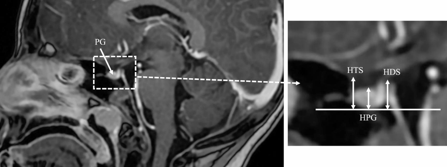 Association of the pituitary gland height with variant sella morphology in children