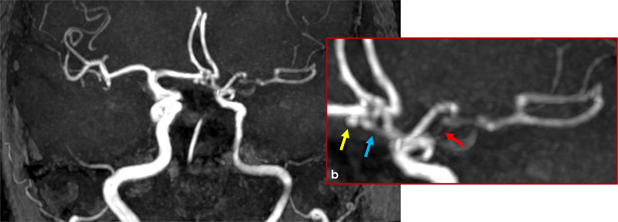 Segmental agenesis of the internal carotid artery without proximal regression: an embryological clue for a new segment of the internal carotid artery?