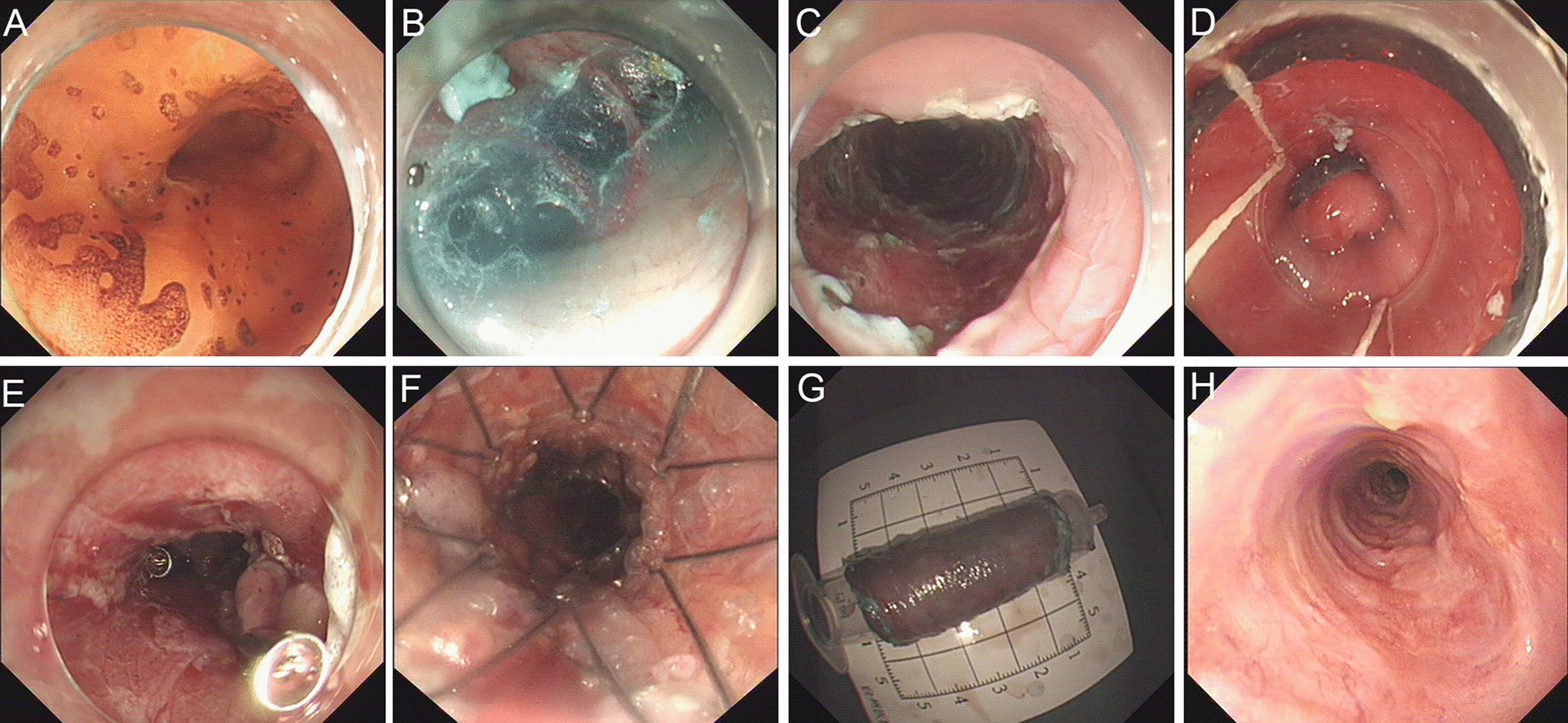 Esophageal mucosal auto-transplantation versus acellular dermal matrix transplantation for preventing esophageal stenosis after endoscopic resection in patients with superficial esophageal mucosal lesions
