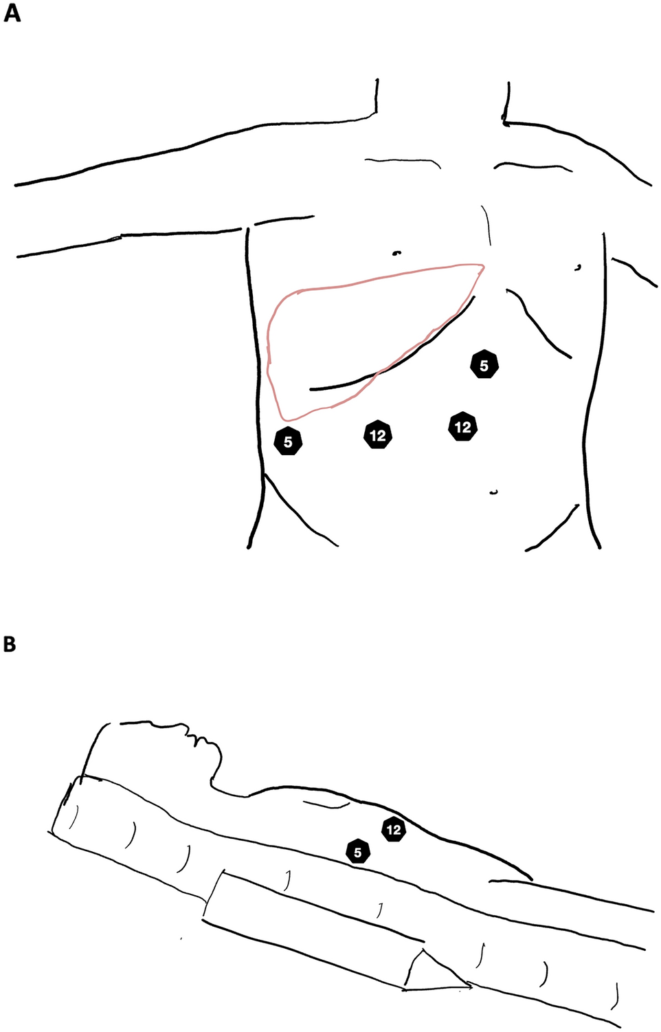What matters in laparoscopic hepatectomy for lesions located in posterosuperior segments? Initial experiences and analysis of risk factors for postoperative complications: a retrospective cohort study