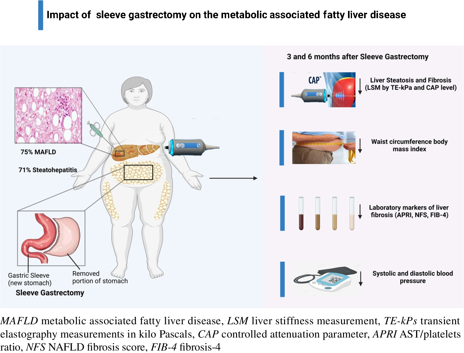Impact of sleeve gastrectomy on the course of metabolic associated fatty liver disease