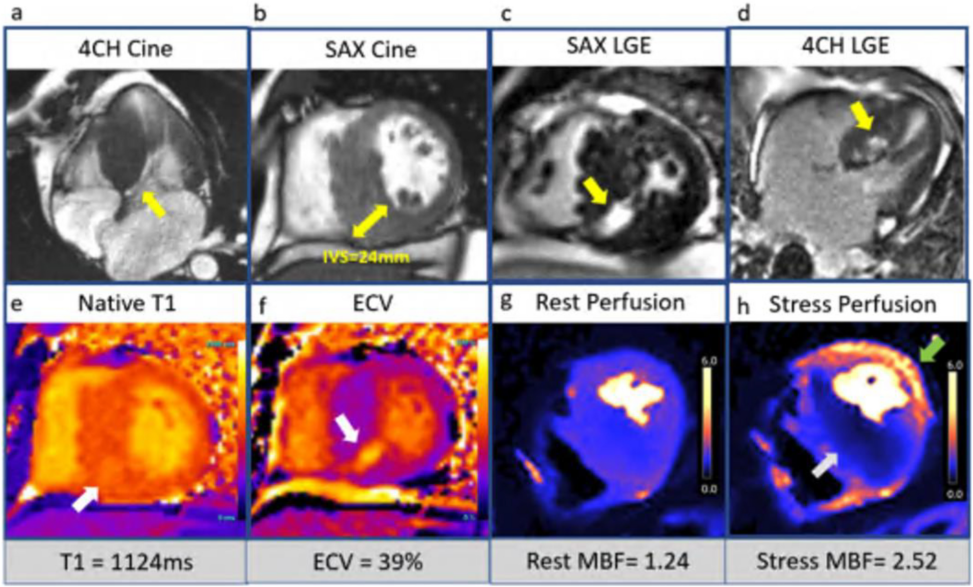 Cardiac Magnetic Resonance Guidance for the Pathogenetic Definition of Cardiomyopathies